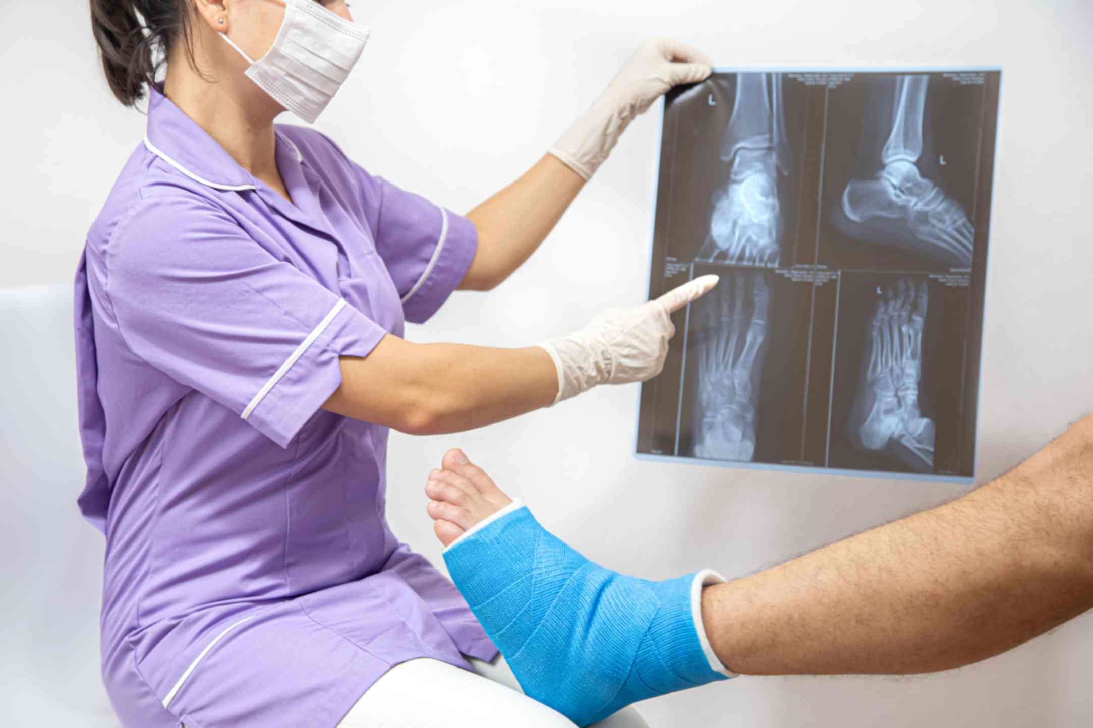 X-ray of fractured bone