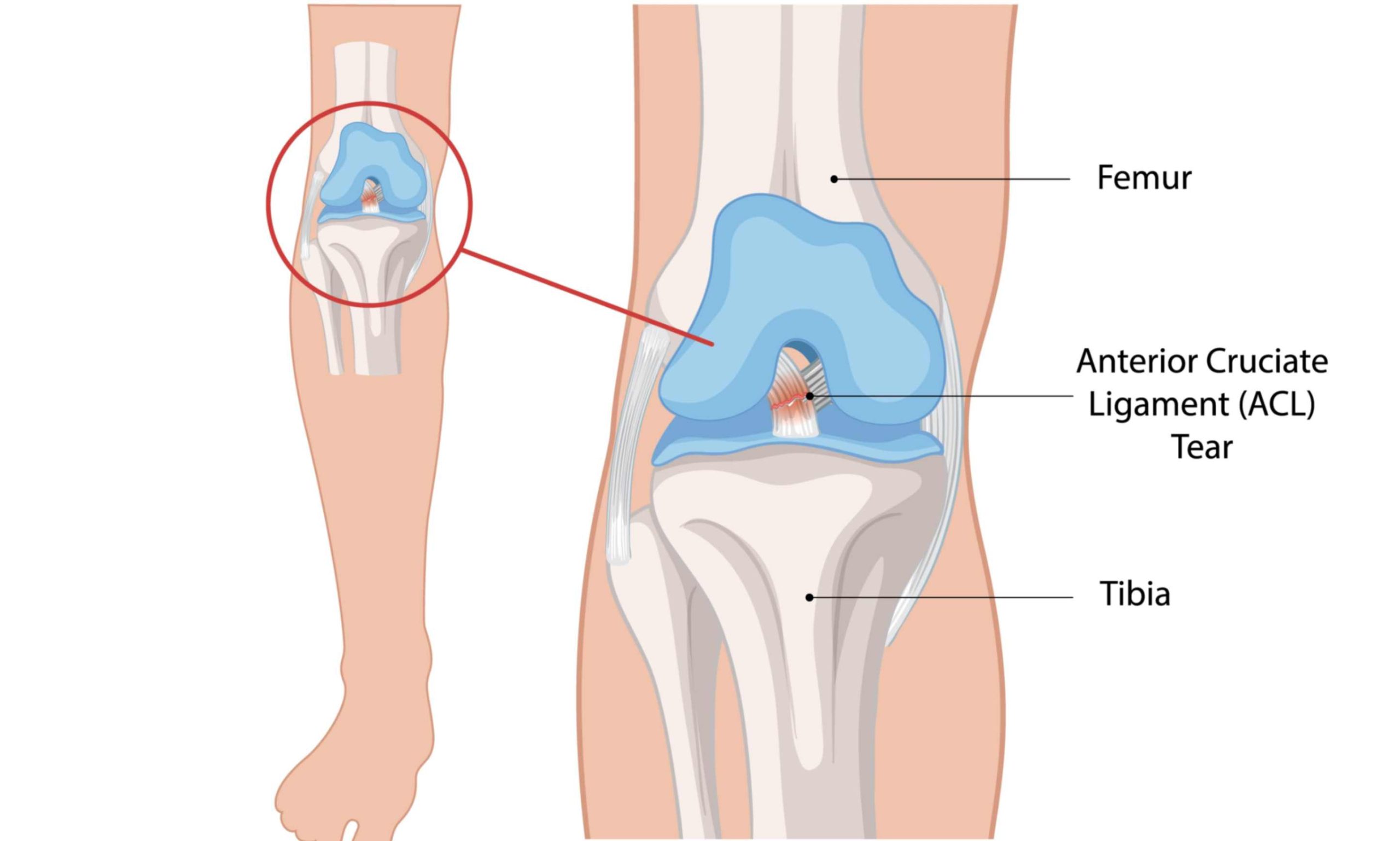 Ligament injury consultation